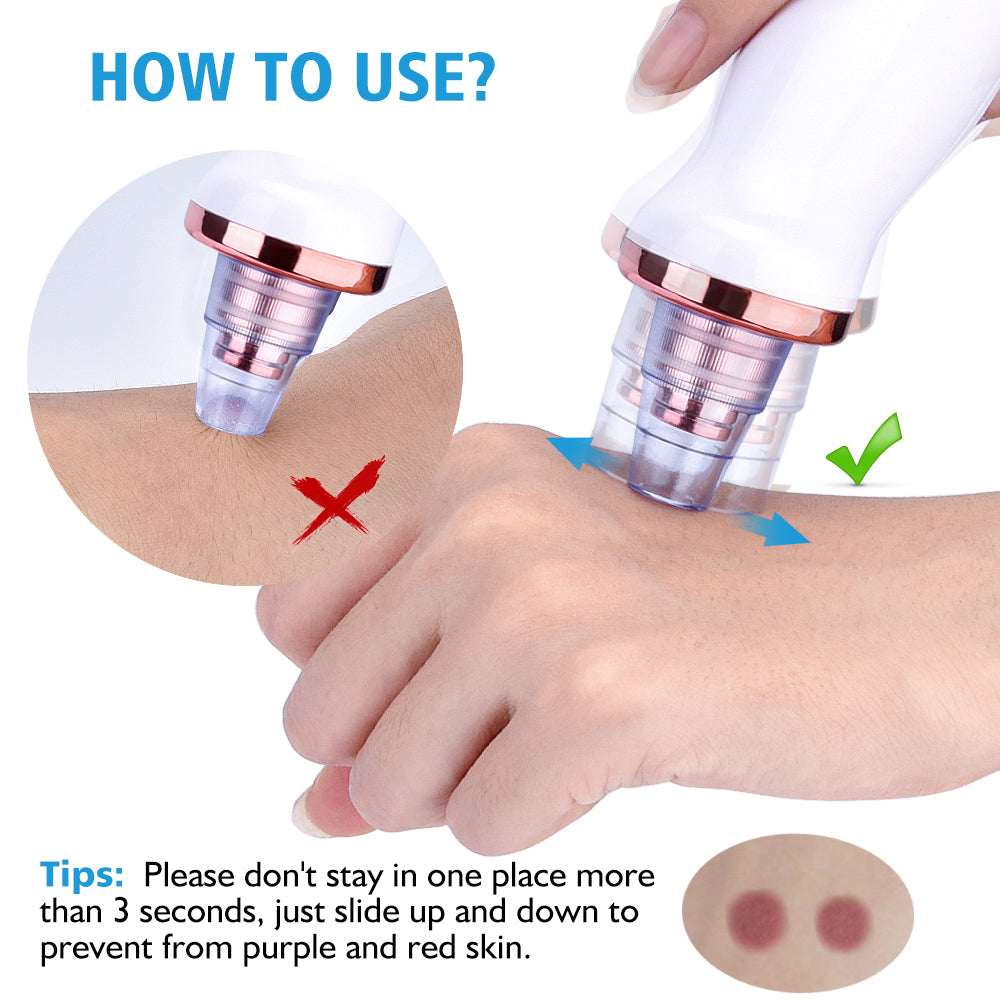 Poreva pore vacuum blackhead remover - product photo 4 - AVALDEY