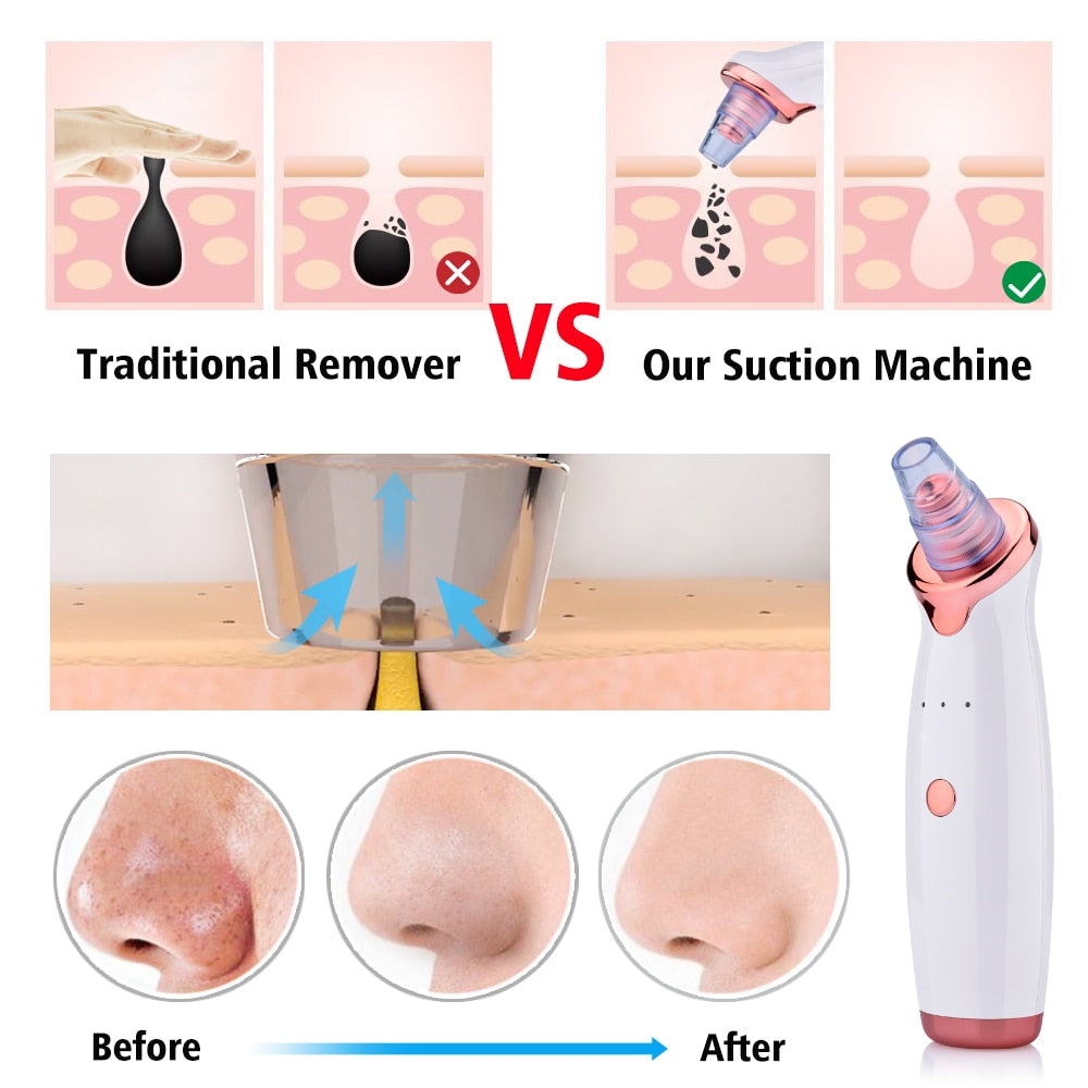 Poreva pore vacuum blackhead remover - product photo 3 - AVALDEY
