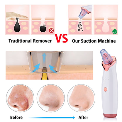 Poreva pore vacuum blackhead remover - product photo 3 - AVALDEY